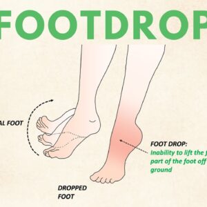 Foot Drop