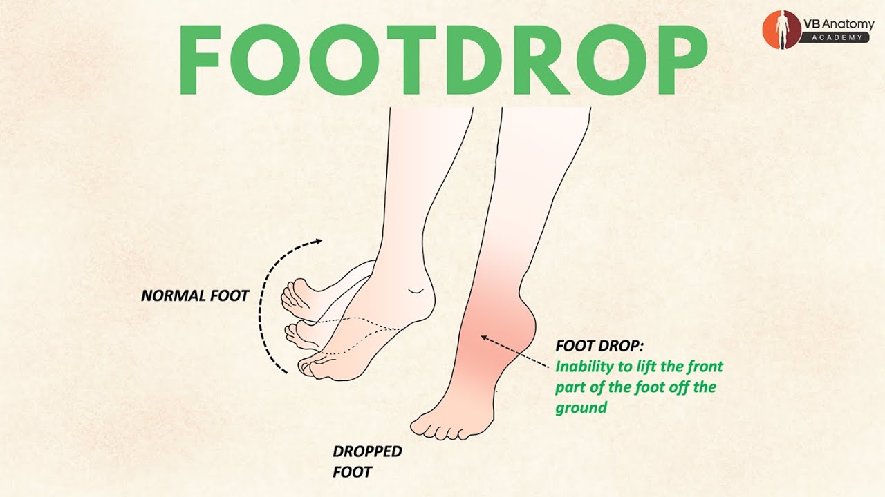 Foot Drop - VB Anatomy