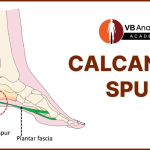 Calcaneal Spur